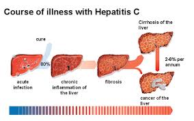 hepatitis1